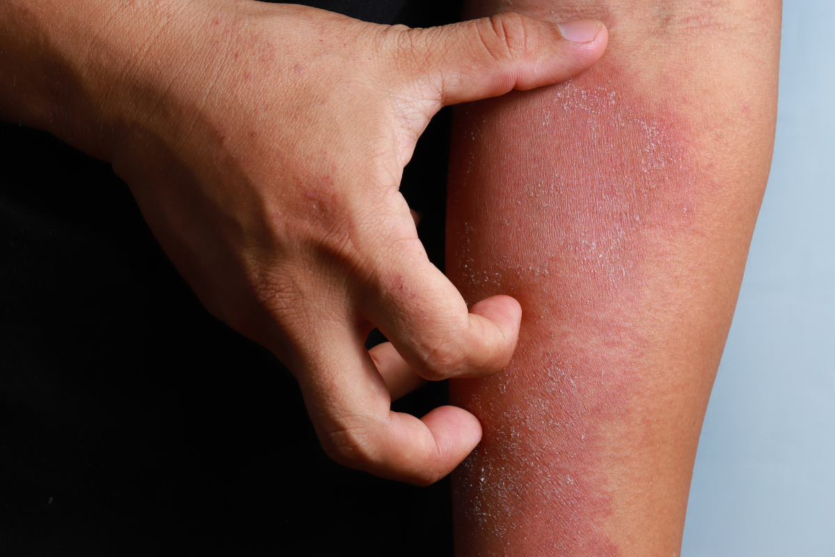 A close-up of a hand scratching inflamed, dry, and flaky skin on an arm, illustrating an eczema flare-up. Text overlay reads: "Summer Eczema Flare-Ups: Why Heat and Sweat Make It Worse and What You Can Do." Nature of Skin Dermatology blog graphic.