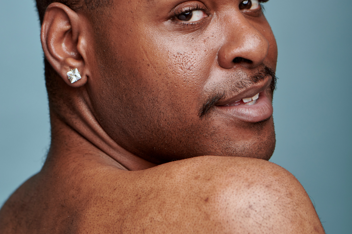 A young Black man looks over his bare shoulder toward the camera, with visible dark spots on his skin against a soft blue studio background. Text overlay reads: "Hyperpigmentation and Sun Exposure: What Patients with Skin of Color Need to Know." Nature of Skin Dermatology latest blog graphic.