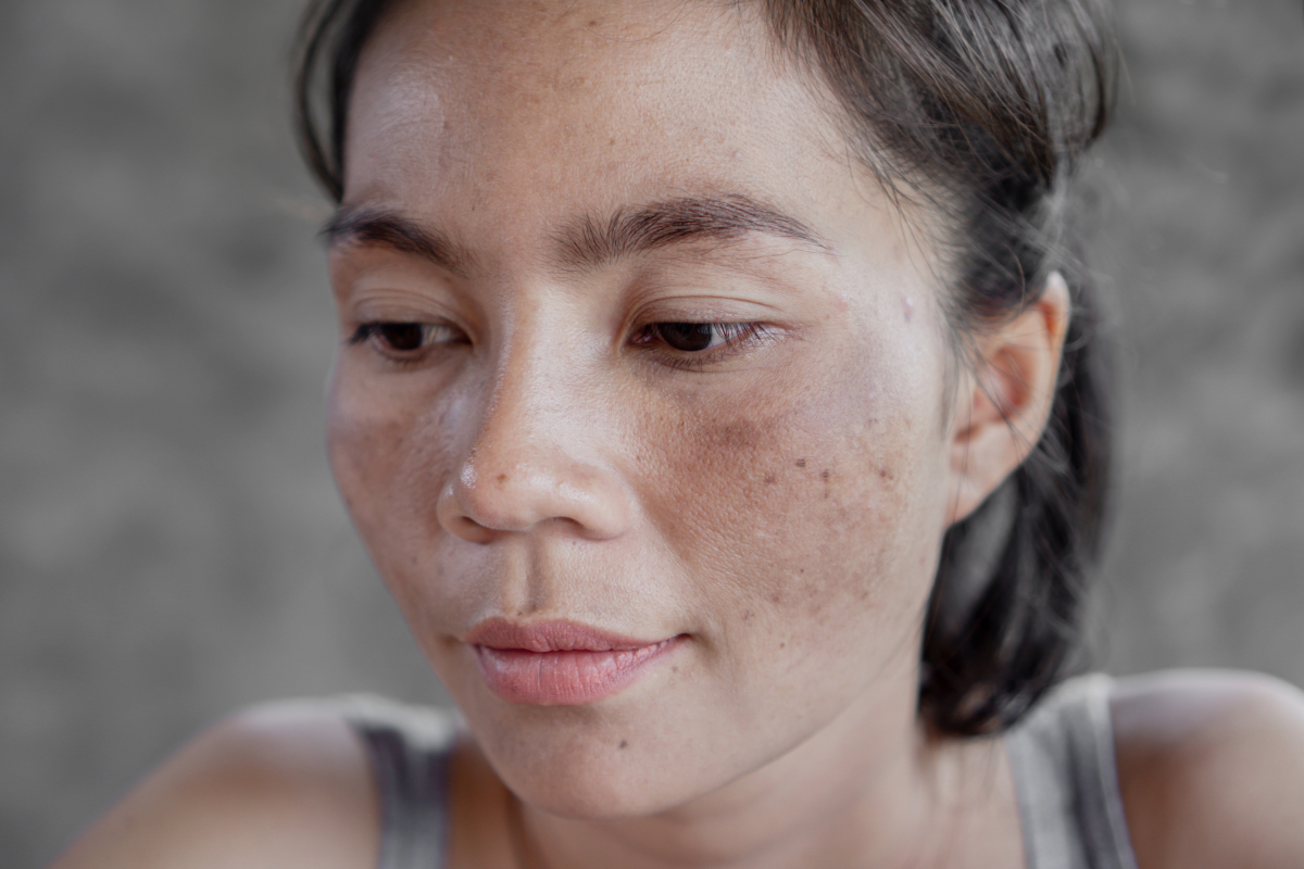 Close-up portrait of a woman with visible dark spots and hyperpigmentation on her face, illustrating sun damage on skin of color. Text overlay reads: "Sun-Damaged Skin: How to Repair and Protect Your Skin This Summer in Austin." Nature of Skin Dermatology latest blog graphic.
