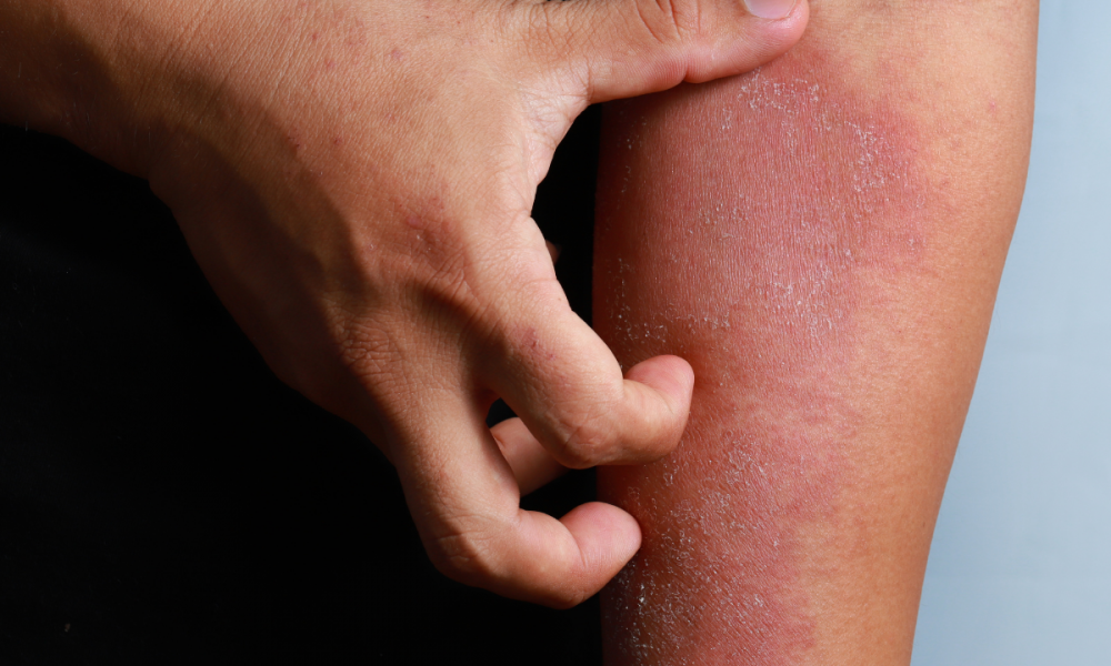 A close-up of a hand scratching inflamed, dry, and flaky skin on an arm, illustrating an eczema flare-up. Text overlay reads: "Summer Eczema Flare-Ups: Why Heat and Sweat Make It Worse and What You Can Do." Nature of Skin Dermatology blog graphic.