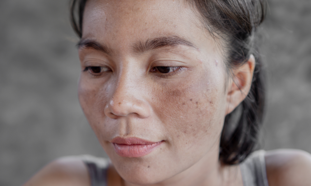 Close-up portrait of a woman with visible dark spots and hyperpigmentation on her face, illustrating sun damage on skin of color. Text overlay reads: "Sun-Damaged Skin: How to Repair and Protect Your Skin This Summer in Austin." Nature of Skin Dermatology latest blog graphic.
