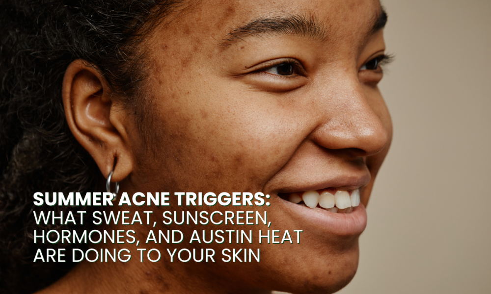 Summer Acne Triggers: What Sweat, Sunscreen, Hormones, and Austin Heat Are Doing to Your Skin