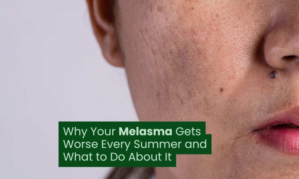 Why Your Melasma Gets Worse Every Summer and What to Do About It
